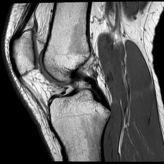 MRI Right Knee With Contrast